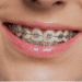 dental braces Adelaide
