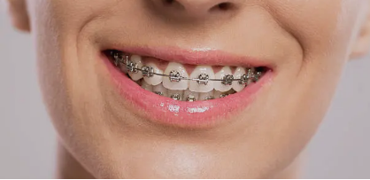 dental braces Adelaide